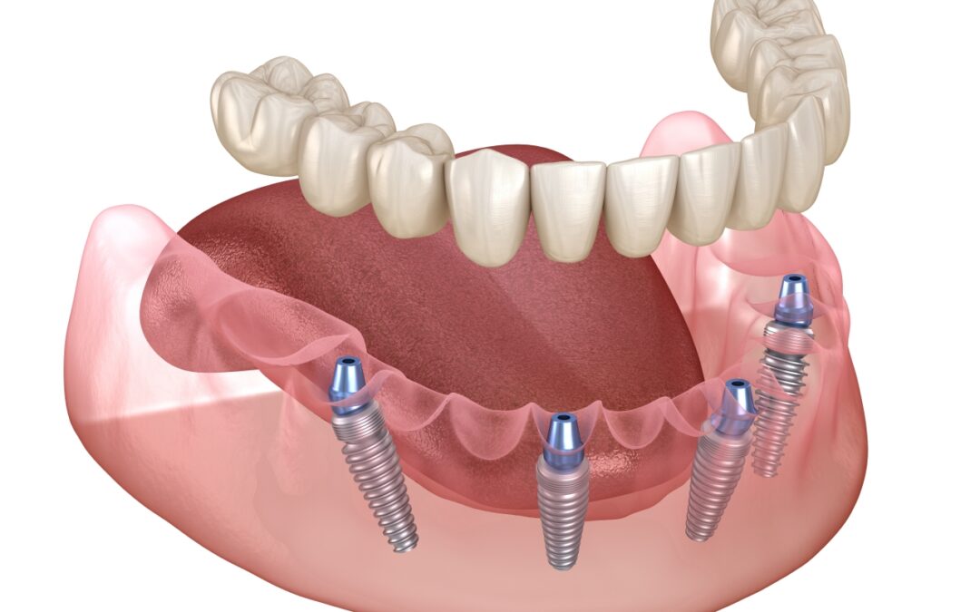 After an All-on-4 Procedure: What Can I Expect?