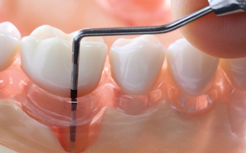 Tartar Causes Periodontal Disease: It’s Not Just Unsightly