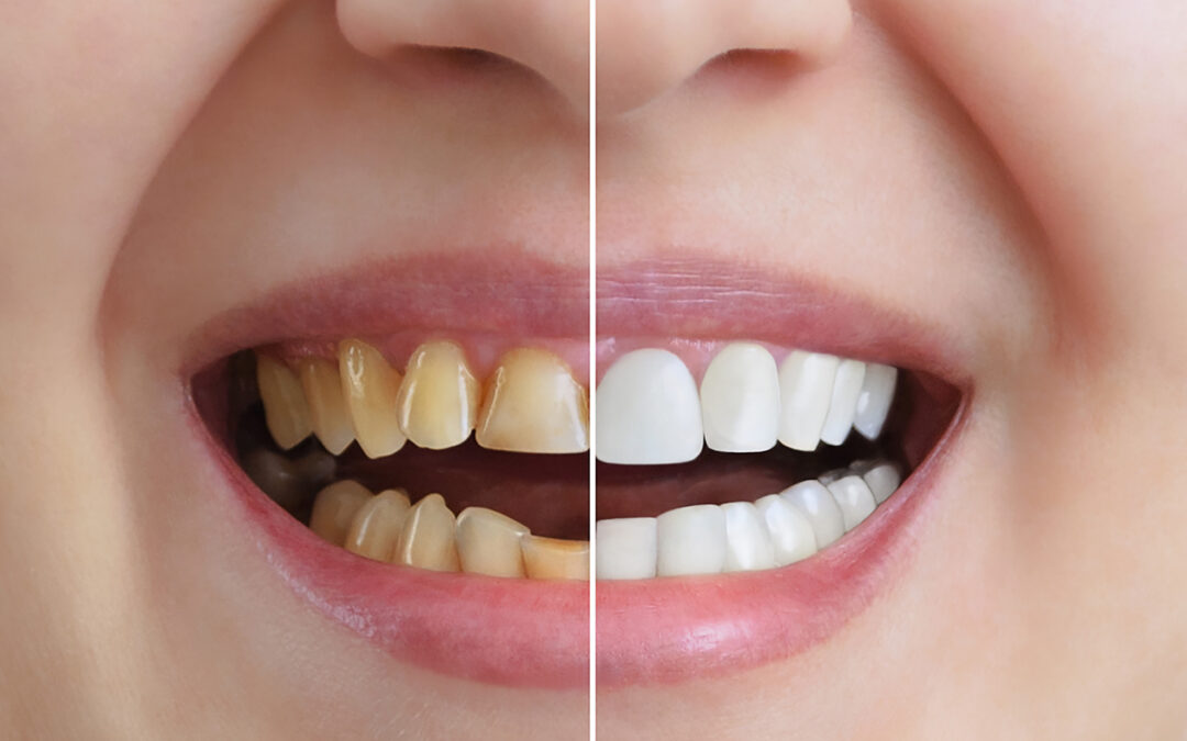 Cosmetic Dentists: Rhinoplasty May Improve Digital Smile Design