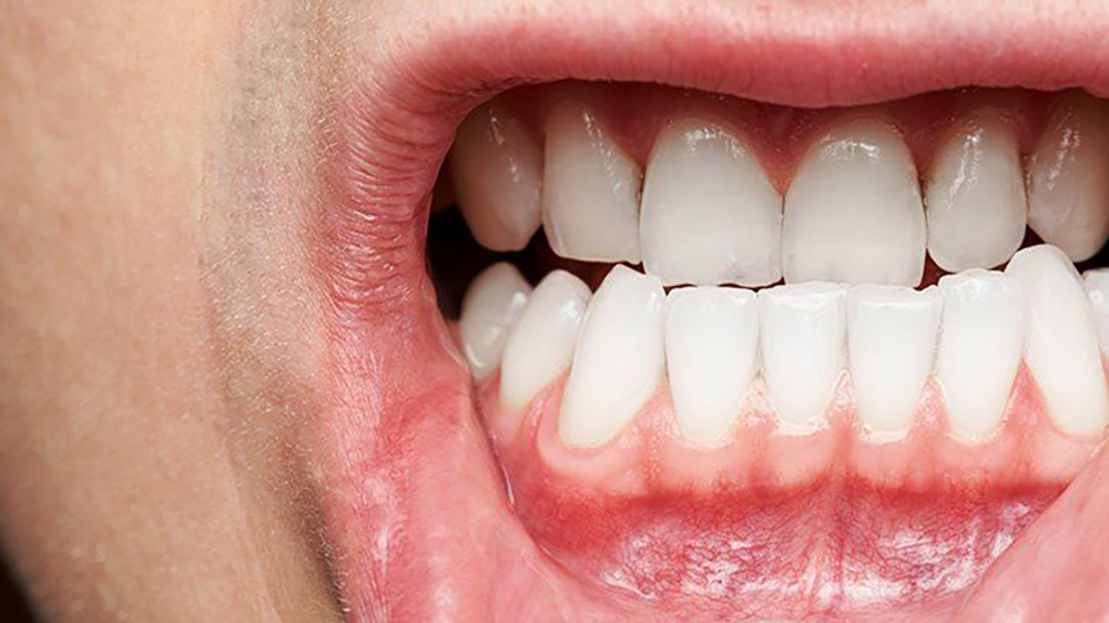 Periodontitis – What causes Gum Disease?