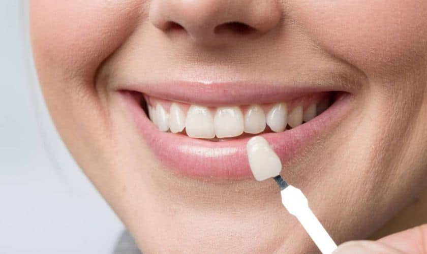 Porcelain Veneers: Judge a Tooth by Its Cover?
