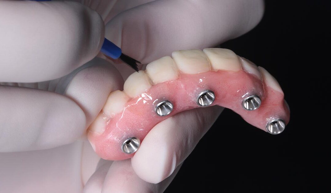 All On 4 dental implants
