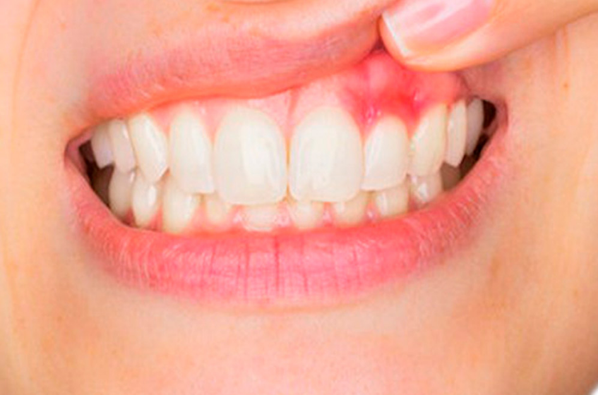 Periodontitis Gum Disease Treatments
