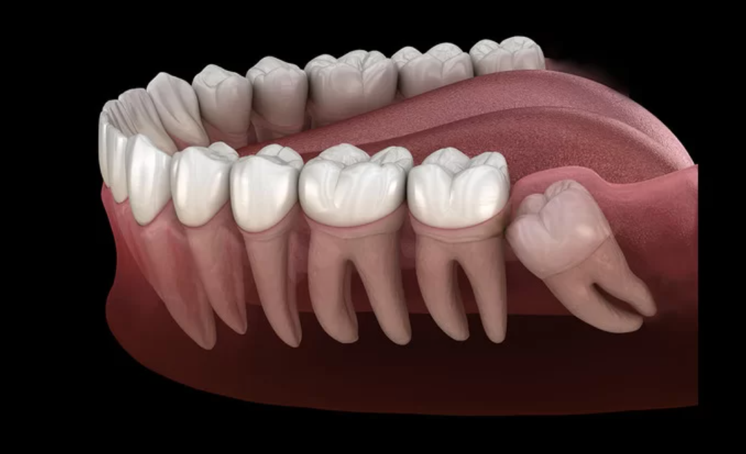 Wisdom Teeth Removal: Pain Mitigation Possibilities