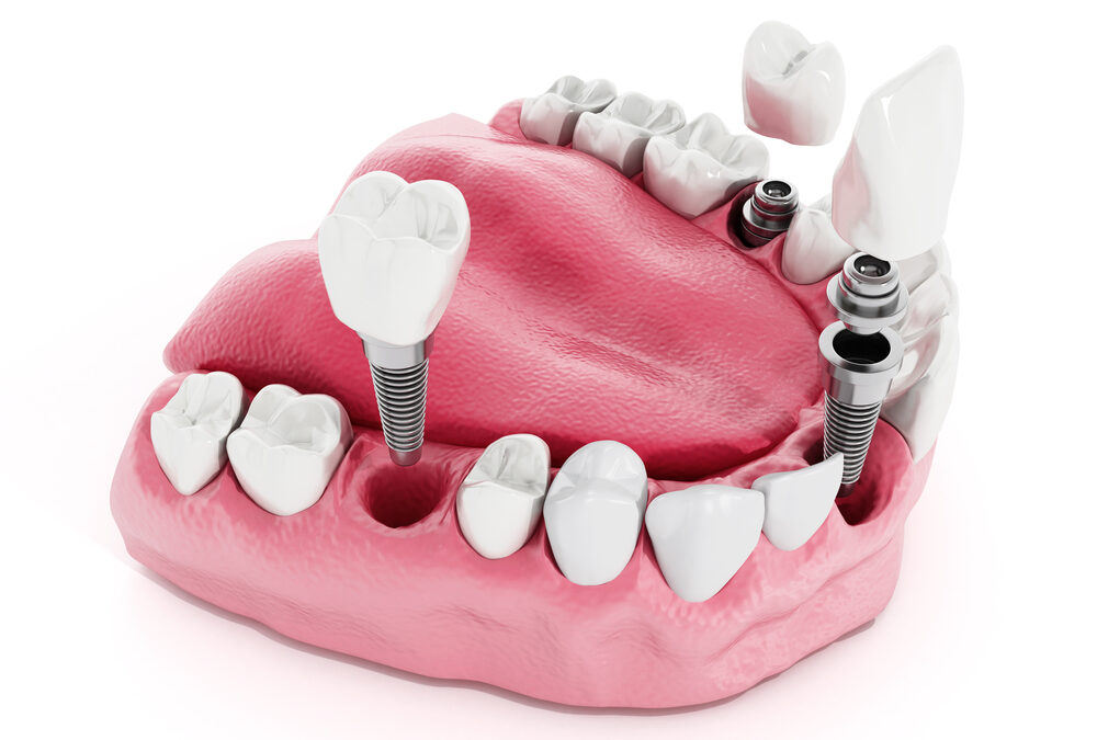 Dental Implantology