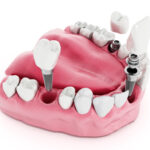 Dental Implantology