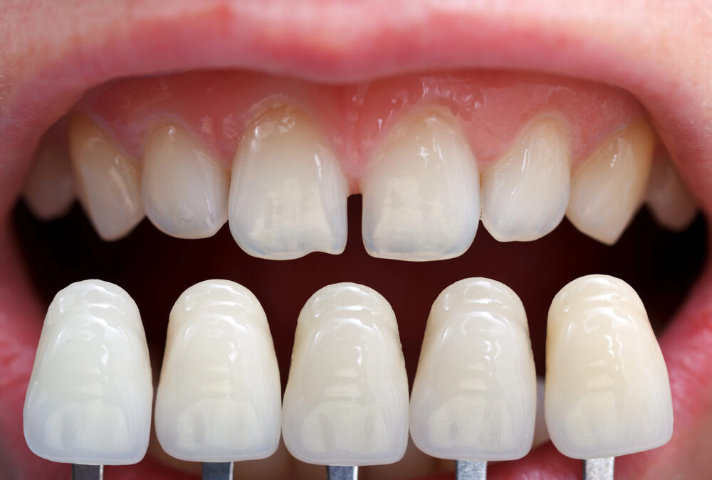 porcelain veneers