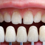 porcelain veneers