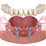 All-on-4 dental procedure