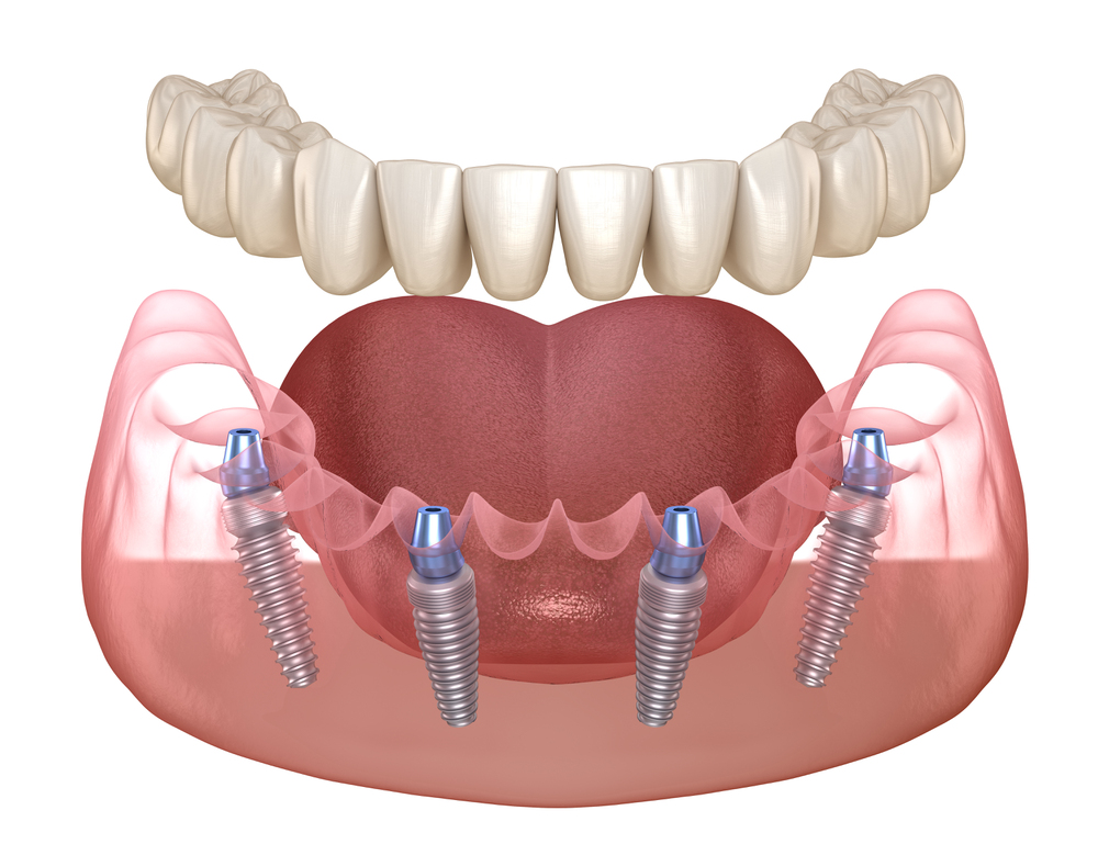 All-on-4 dental procedure