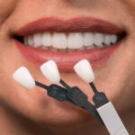 veneers