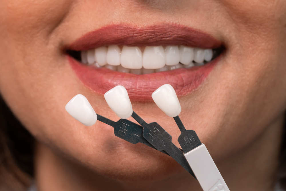 Veneers Cost vs. Value: Investing in a Smile That Lasts