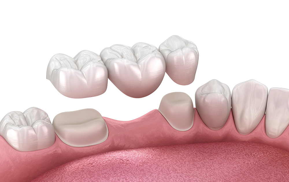 The Evolution of Dental Crowns: A Journey Through Technological Progress